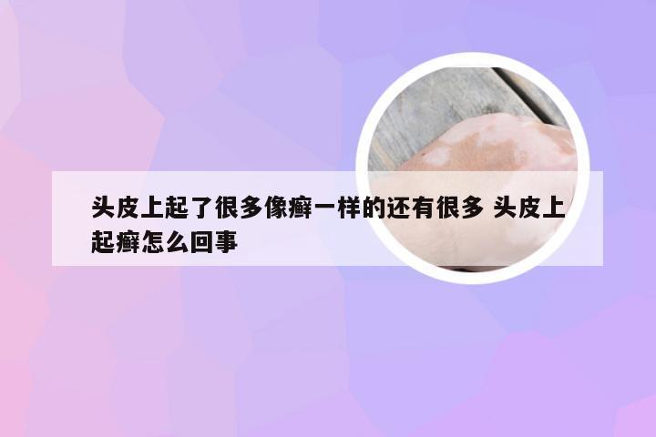 头皮上起了很多像癣一样的还有很多 头皮上起癣怎么回事