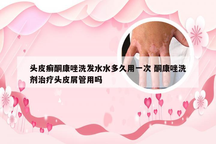 头皮癣酮康唑洗发水水多久用一次 酮康唑洗剂治疗头皮屑管用吗