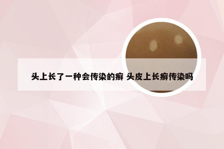 头上长了一种会传染的癣 头皮上长癣传染吗