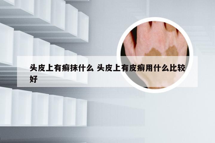 头皮上有癣抹什么 头皮上有皮癣用什么比较好
