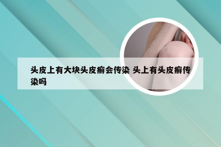 头皮上有大块头皮癣会传染 头上有头皮癣传染吗