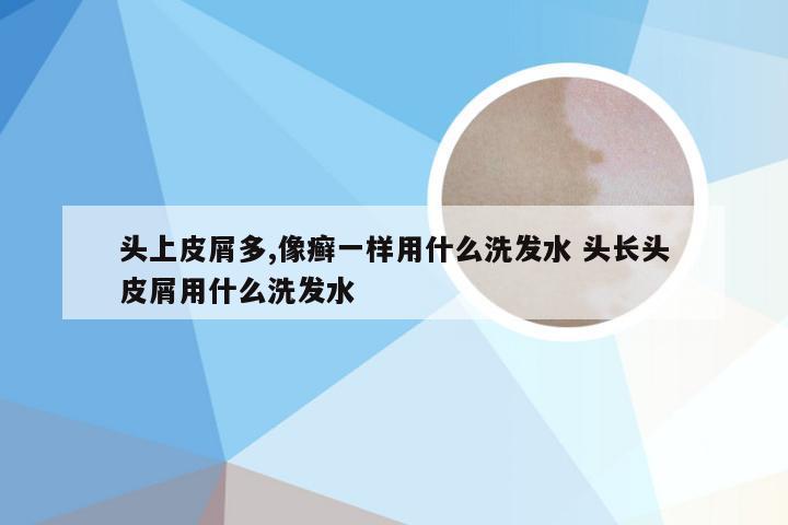 头上皮屑多,像癣一样用什么洗发水 头长头皮屑用什么洗发水