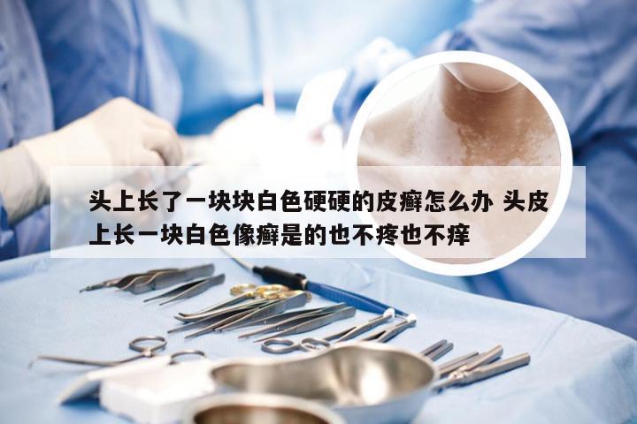 头上长了一块块白色硬硬的皮癣怎么办 头皮上长一块白色像癣是的也不疼也不痒