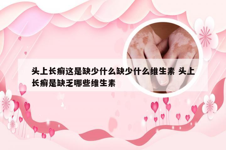 头上长癣这是缺少什么缺少什么维生素 头上长癣是缺乏哪些维生素