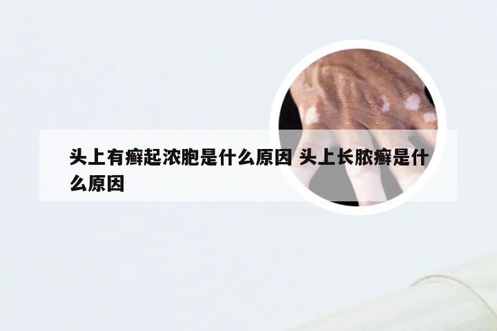 头上有癣起浓胞是什么原因 头上长脓癣是什么原因