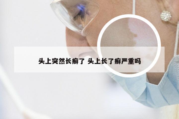 头上突然长癣了 头上长了癣严重吗