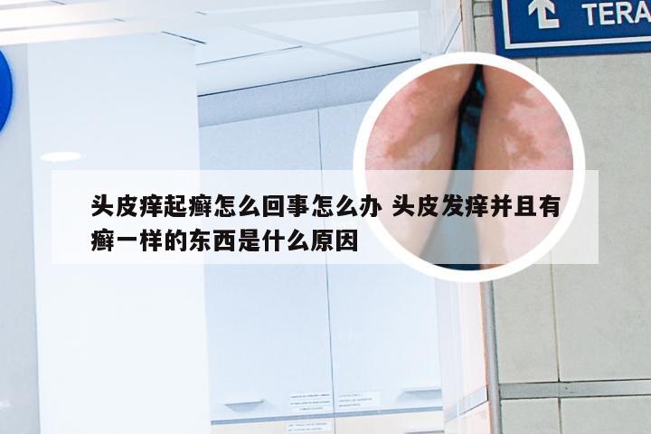 头皮痒起癣怎么回事怎么办 头皮发痒并且有癣一样的东西是什么原因