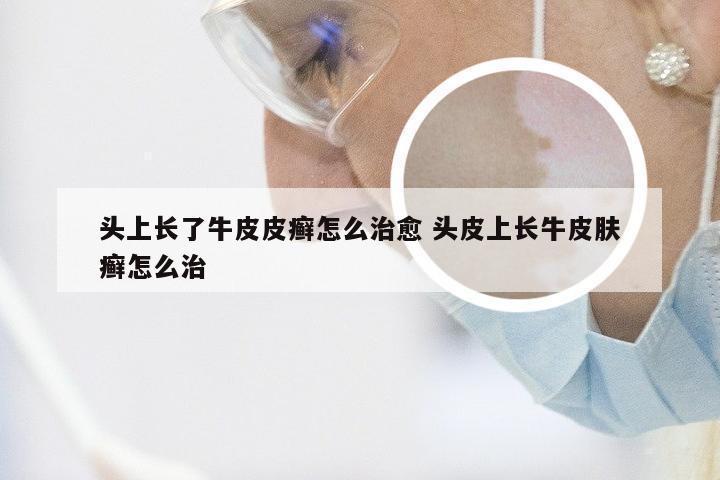 头上长了牛皮皮癣怎么治愈 头皮上长牛皮肤癣怎么治