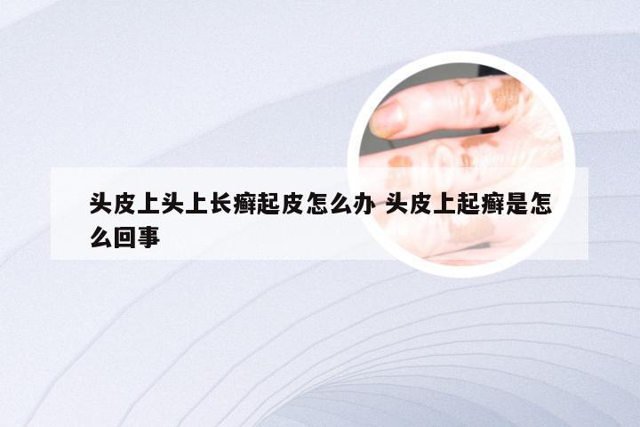 头皮上头上长癣起皮怎么办 头皮上起癣是怎么回事
