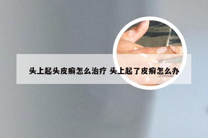头上起头皮癣怎么治疗 头上起了皮癣怎么办