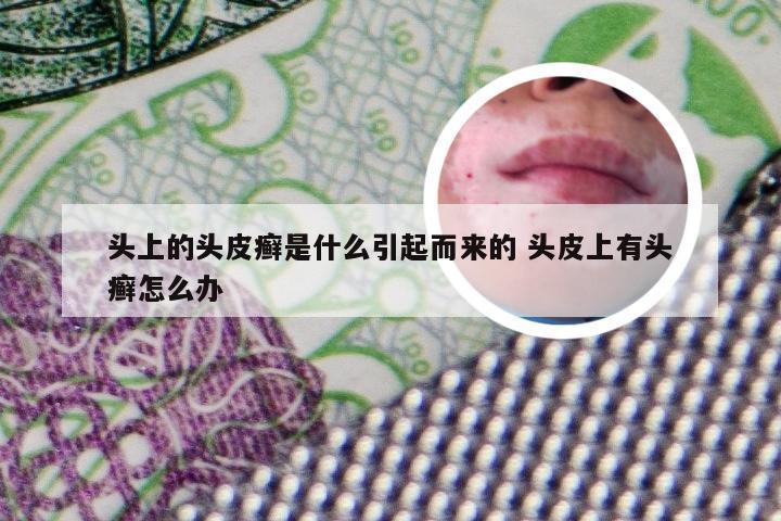 头上的头皮癣是什么引起而来的 头皮上有头癣怎么办