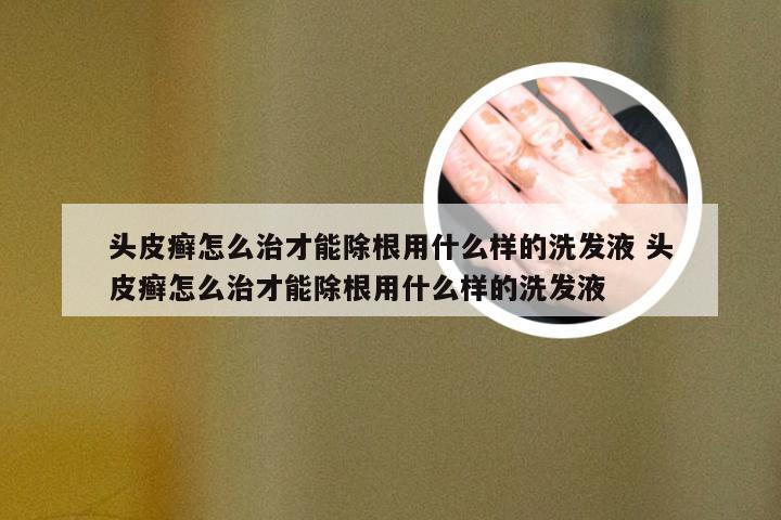 头皮癣怎么治才能除根用什么样的洗发液 头皮癣怎么治才能除根用什么样的洗发液