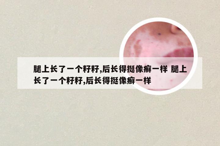 腿上长了一个籽籽,后长得挺像癣一样 腿上长了一个籽籽,后长得挺像癣一样