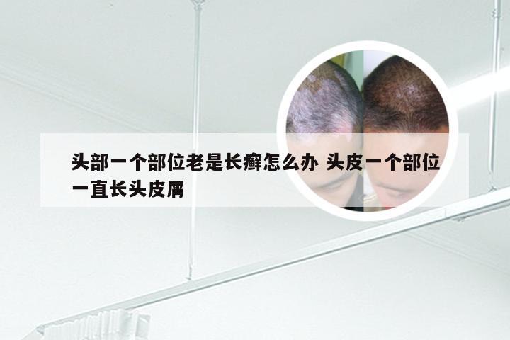 头部一个部位老是长癣怎么办 头皮一个部位一直长头皮屑