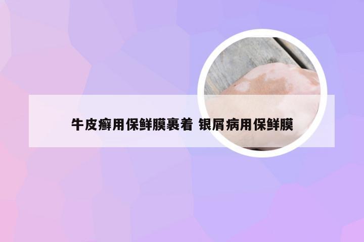 牛皮癣用保鲜膜裹着 银屑病用保鲜膜