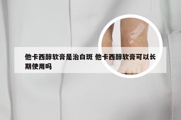 他卡西醇软膏是治白斑 他卡西醇软膏可以长期使用吗
