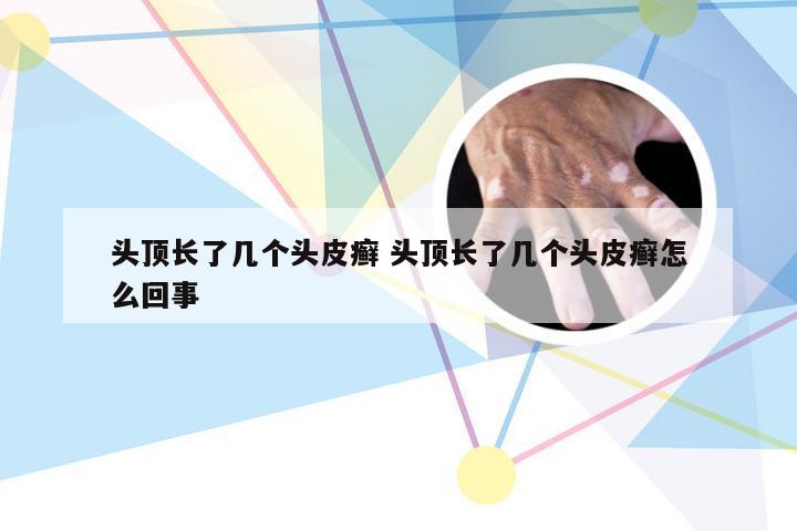 头顶长了几个头皮癣 头顶长了几个头皮癣怎么回事