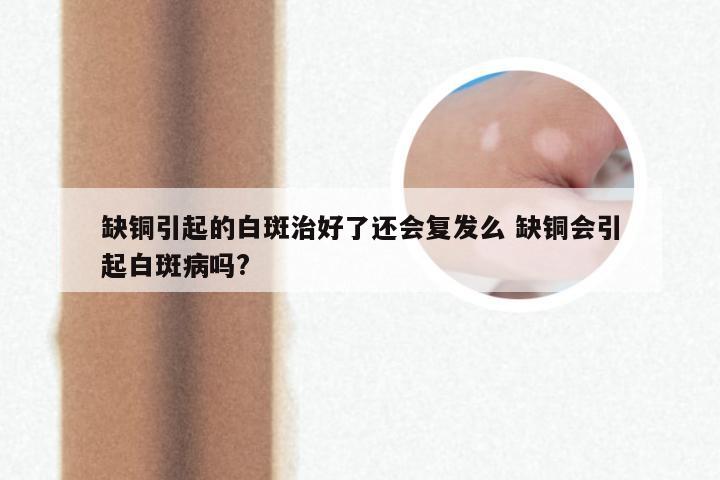 缺铜引起的白斑治好了还会复发么 缺铜会引起白斑病吗?