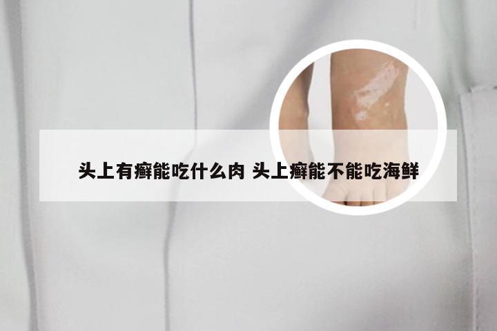 头上有癣能吃什么肉 头上癣能不能吃海鲜