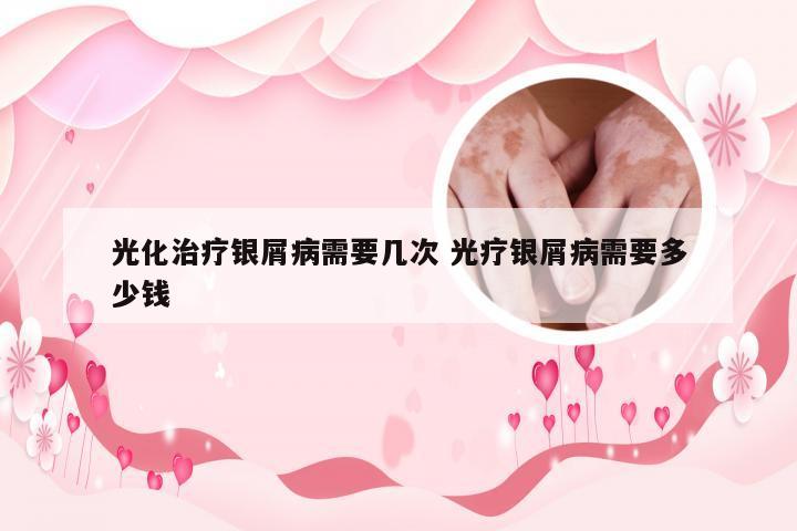 光化治疗银屑病需要几次 光疗银屑病需要多少钱