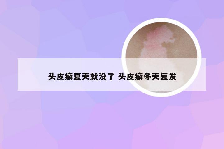 头皮癣夏天就没了 头皮癣冬天复发