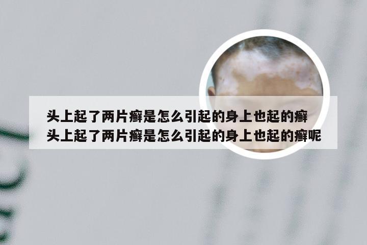 头上起了两片癣是怎么引起的身上也起的癣 头上起了两片癣是怎么引起的身上也起的癣呢