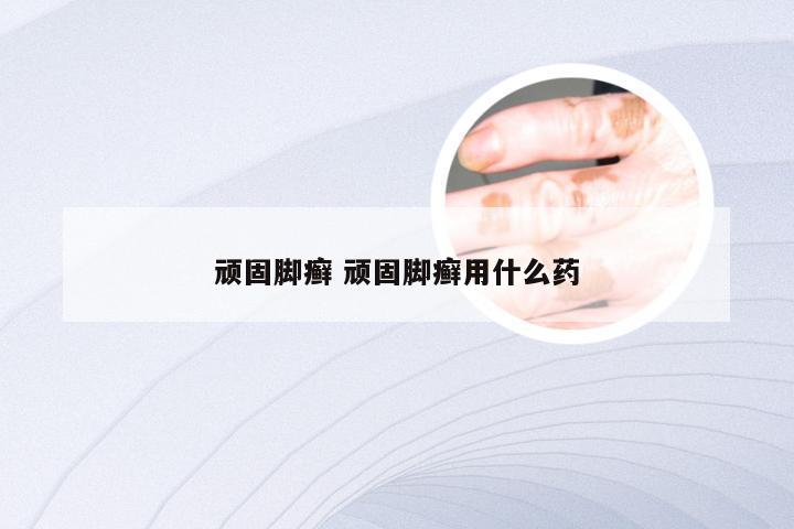 顽固脚癣 顽固脚癣用什么药