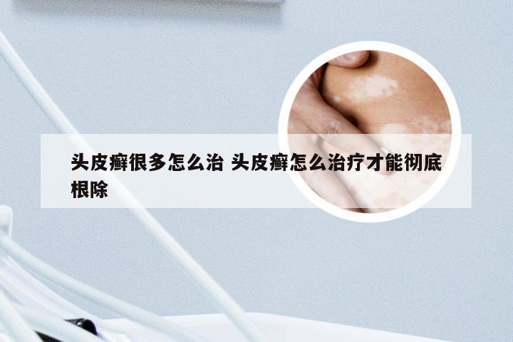 头皮癣很多怎么治 头皮癣怎么治疗才能彻底根除