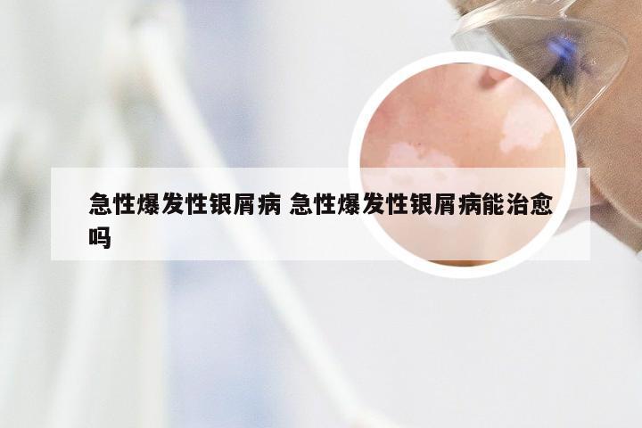 急性爆发性银屑病 急性爆发性银屑病能治愈吗