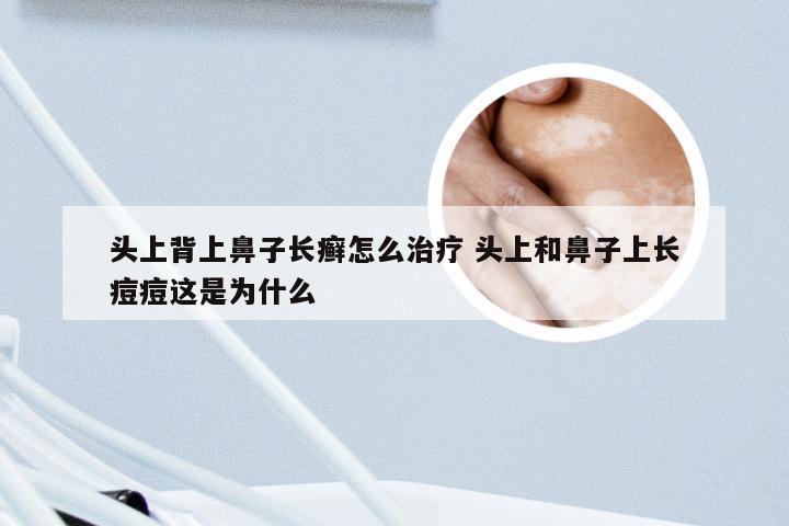 头上背上鼻子长癣怎么治疗 头上和鼻子上长痘痘这是为什么