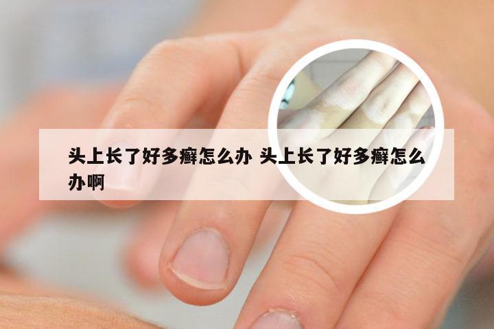 头上长了好多癣怎么办 头上长了好多癣怎么办啊