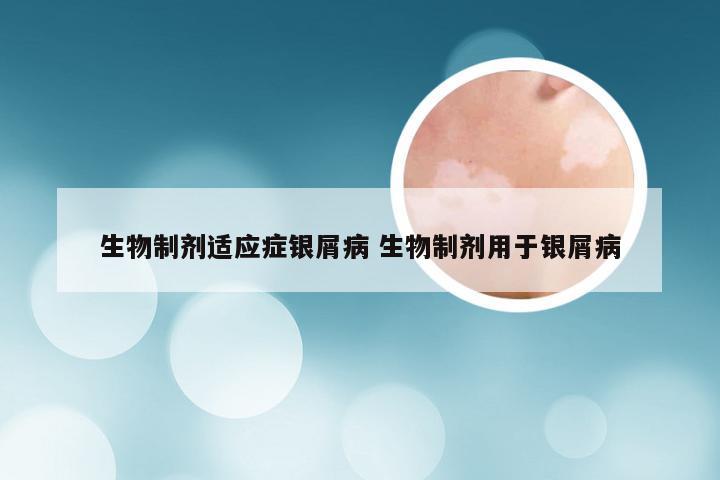 生物制剂适应症银屑病 生物制剂用于银屑病