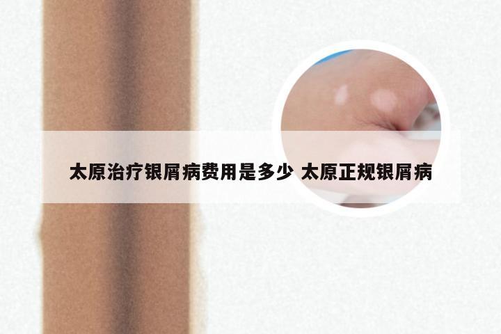 太原治疗银屑病费用是多少 太原正规银屑病
