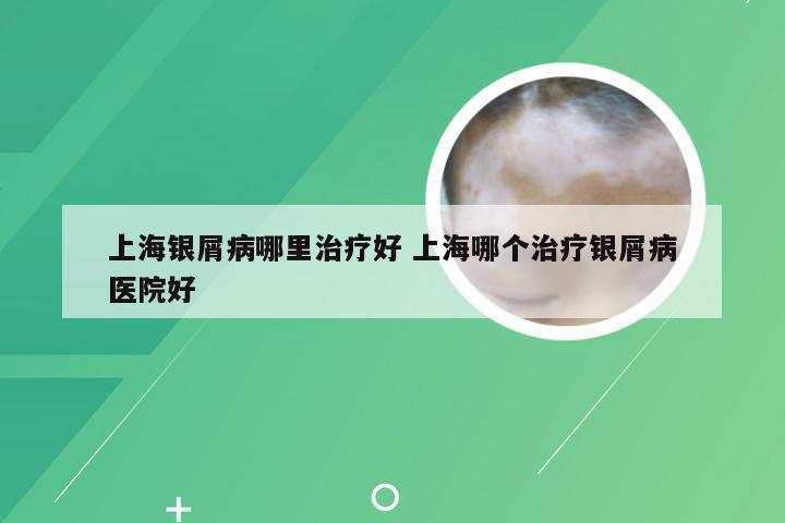 上海银屑病哪里治疗好 上海哪个治疗银屑病医院好
