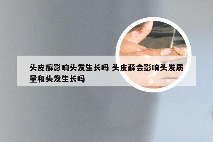 头皮癣影响头发生长吗 头皮藓会影响头发质量和头发生长吗