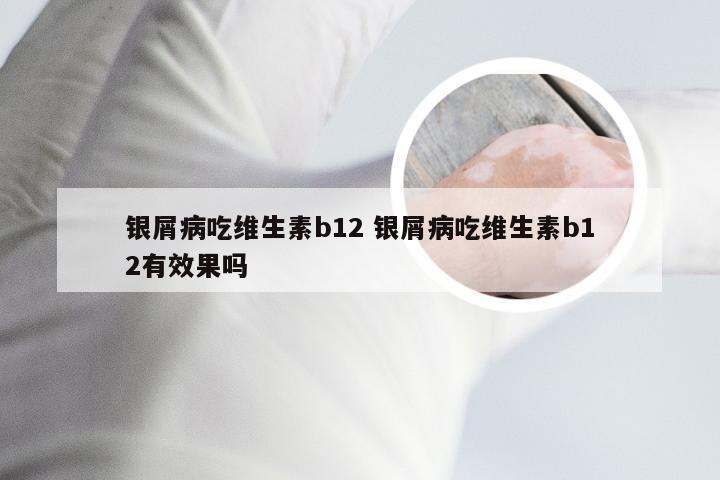 银屑病吃维生素b12 银屑病吃维生素b12有效果吗