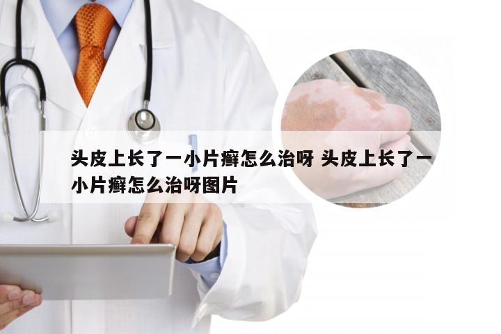 头皮上长了一小片癣怎么治呀 头皮上长了一小片癣怎么治呀图片