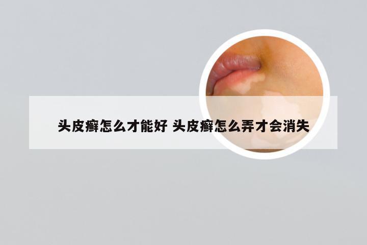 头皮癣怎么才能好 头皮癣怎么弄才会消失