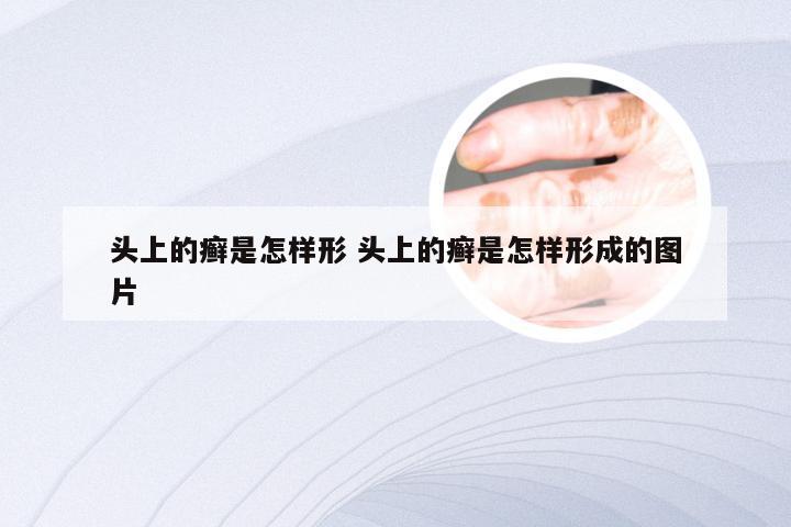 头上的癣是怎样形 头上的癣是怎样形成的图片