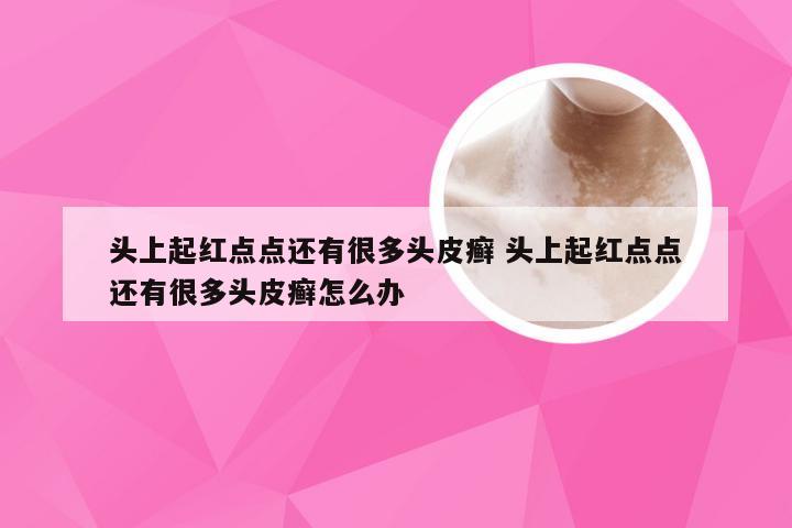 头上起红点点还有很多头皮癣 头上起红点点还有很多头皮癣怎么办