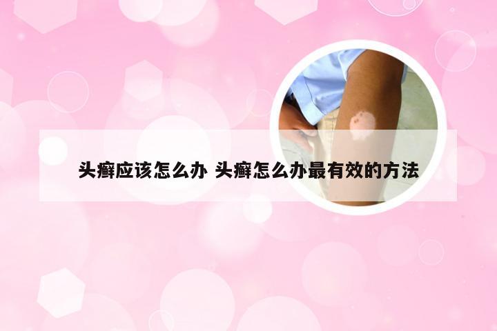 头癣应该怎么办 头癣怎么办最有效的方法