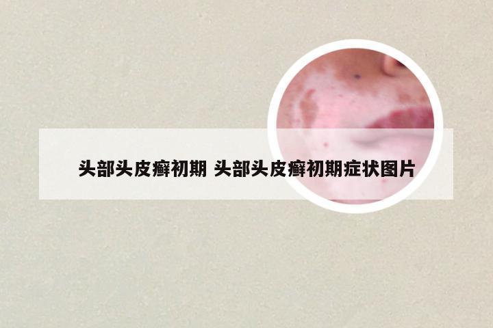 头部头皮癣初期 头部头皮癣初期症状图片