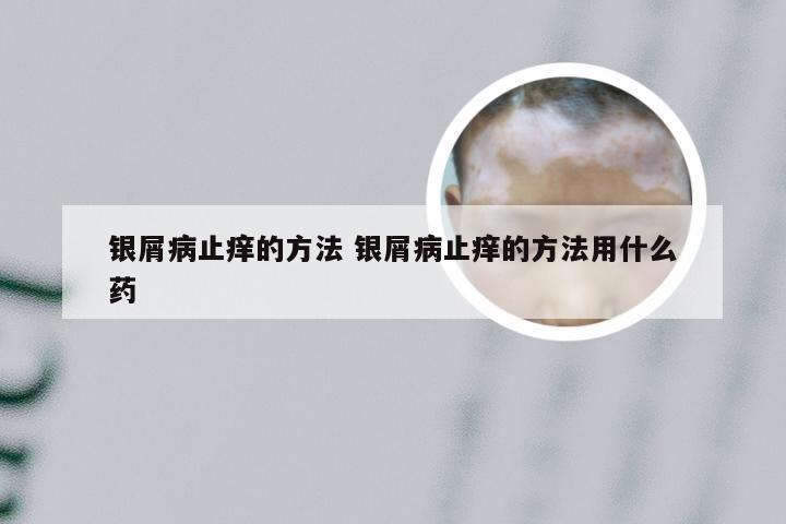 银屑病止痒的方法 银屑病止痒的方法用什么药