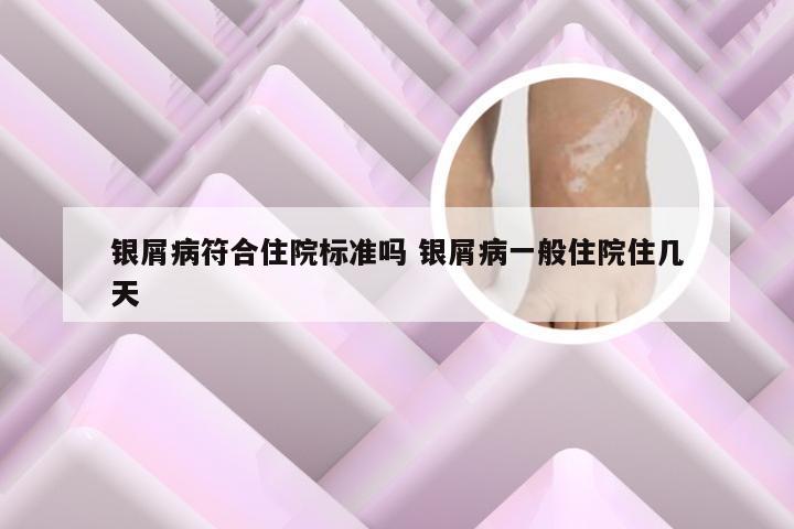 银屑病符合住院标准吗 银屑病一般住院住几天