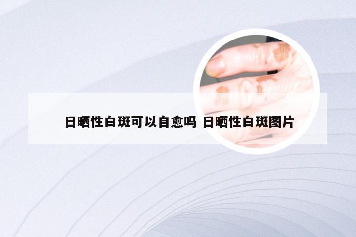 日晒性白斑可以自愈吗 日晒性白斑图片