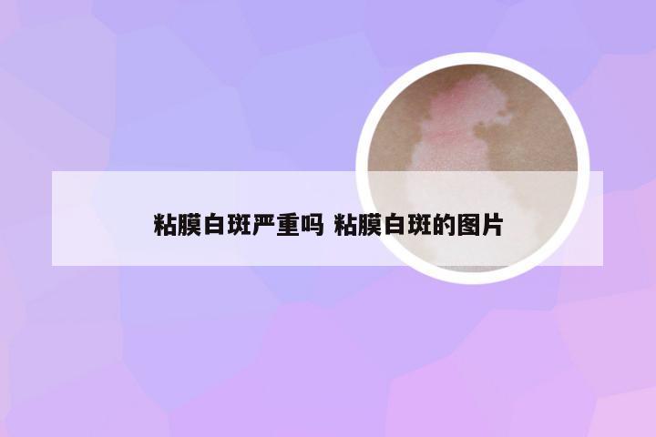 粘膜白斑严重吗 粘膜白斑的图片