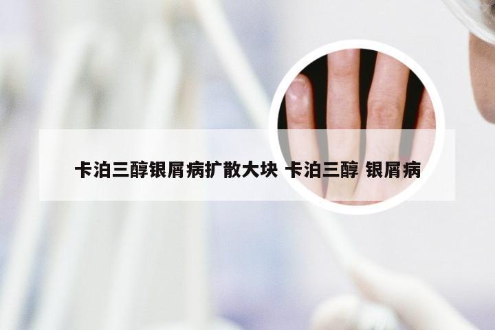 卡泊三醇银屑病扩散大块 卡泊三醇 银屑病
