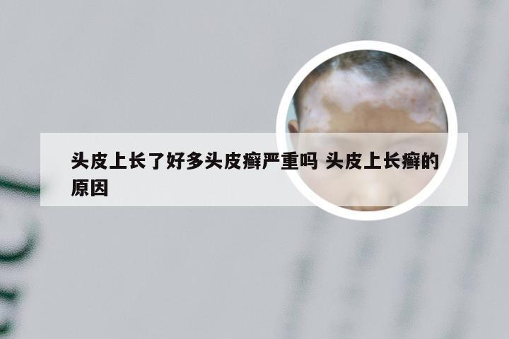头皮上长了好多头皮癣严重吗 头皮上长癣的原因