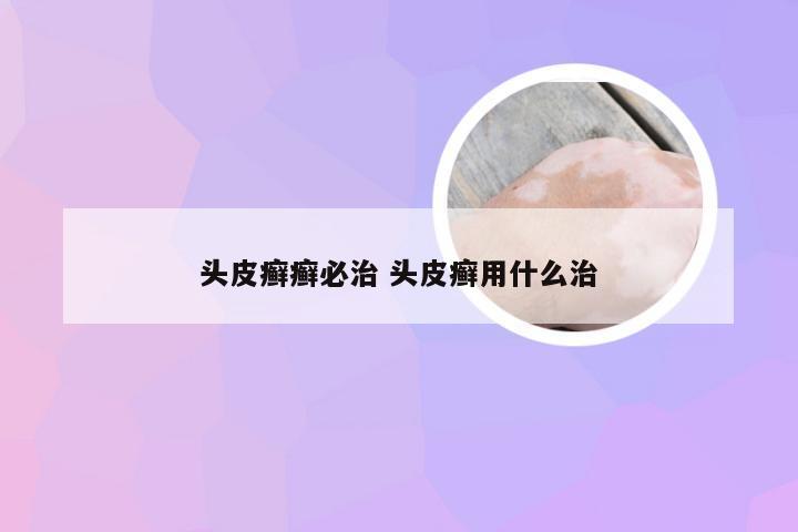 头皮癣癣必治 头皮癣用什么治