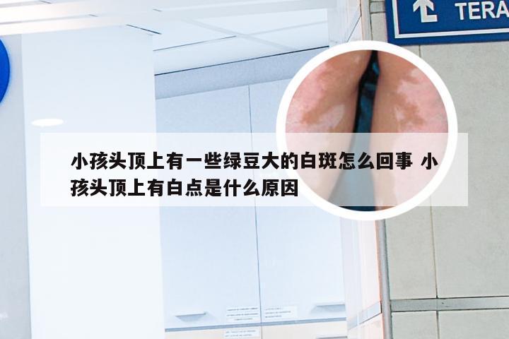 小孩头顶上有一些绿豆大的白斑怎么回事 小孩头顶上有白点是什么原因